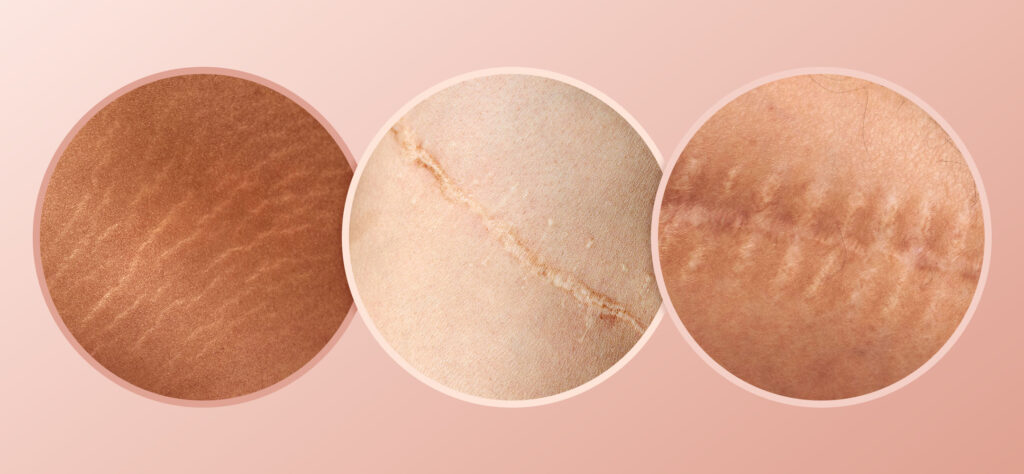 Wie Hautkaschierung und medizinisches Tätowieren nach Narben zu neuem Selbstbewusstsein verhelfen